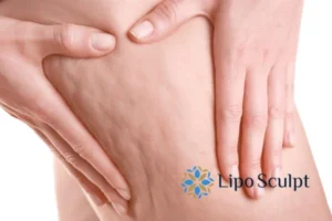 CoolSculpting for Legs: The Innovative Approach to Redefining Your Legs 5 Start your journey today book your coolsculpting treatment Eaton online today!