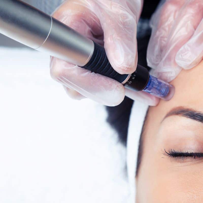 Morpheus8 treatment Eaton from Lipo Sculpt - Book in today!
